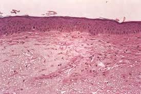 Deep Tissue Injury in Development of Pressure Ulcers: Skin Morphology of Aging Skin Changes occur more rapidly in aged skin: Alterations in collagen