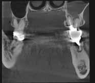 The coronal, sagittal, and axial views all confirm good quality bone around the implant and an