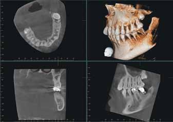 Oral Surgery The patient presented with pain in the maxillary left region.
