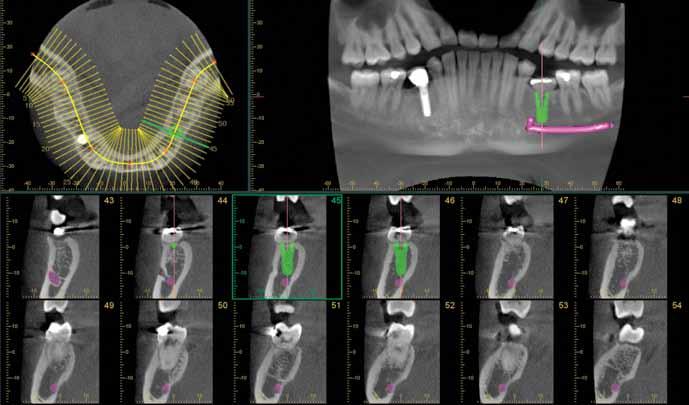 3D Images for Implant Planning Planning Process Successful placement of implants starts with the very critical and detailed planning process.