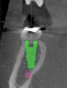 Veraviewepocs 3D R100 is ideal for implant planning with full arch imaging, industry leading clarity, and low dosage to the patient. Software i-dixel 2.