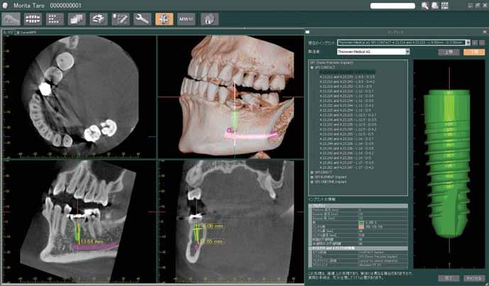 Advanced Software Features Confirm Implant Position with Volume Rendered Image A high resolution volume rendered image of the entire jaw can be created.