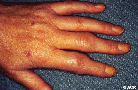 Rheumatic diseases Rheumatoïd arthritis (RA): F>M Hands, feet, all joints Psoriatic Arthritis