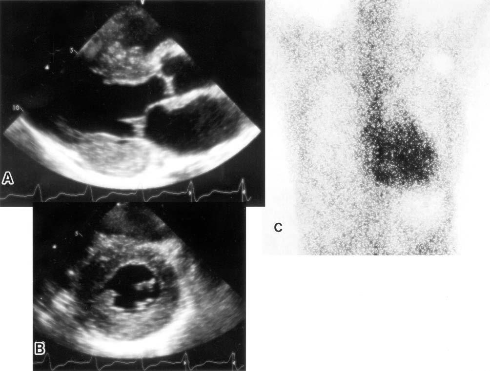 IKEDA Figure 2. Representative echocardigram and Tc-99m-PYP scintigram of cardiac amyloidosis seen in a hereditary amyloidosis patient with ATTRSer50Ile.