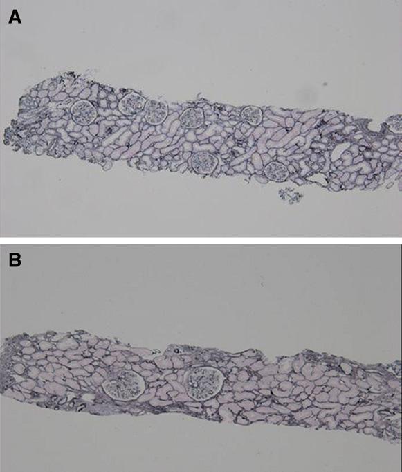 Clin J Am Soc Nephrol 7: 735 741, May, 2012 Glomerular Density in Obesity-Related Glomerulopathy, Tsuboi et al. 737 Figure 1.