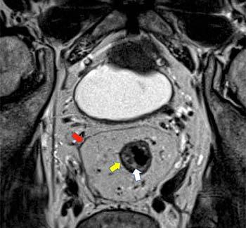 Role of MRI for Staging Rectal Cancer High-resolution MRI has supplanted endoscopic ultrasound for staging rectal cancer.