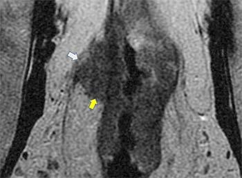Figure 2. Multiplanar T2-weighted images showing a low rectal tumor (arrows) at the level of the levators and confined to the rectal wall.