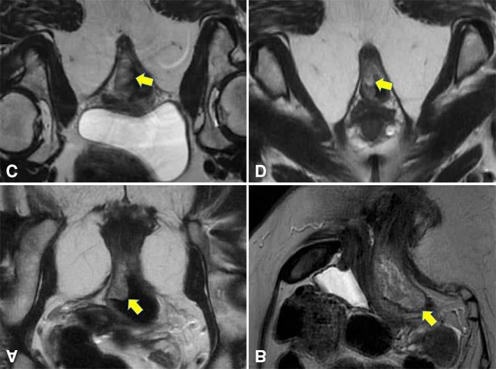 This finding has led to the routine (and for many countries mandatory) use of high-resolution rectal MRI for the preoperative assessment of patients.