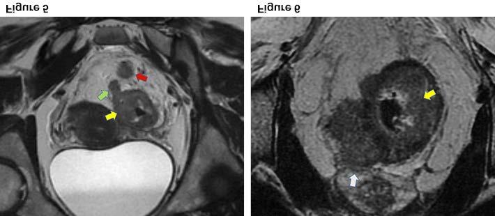Figure 5. Axial T2-weighted MRI showing a mid-rectal tumor (yellow arrow) with a metastatic mesorectal lymph node (red arrow).