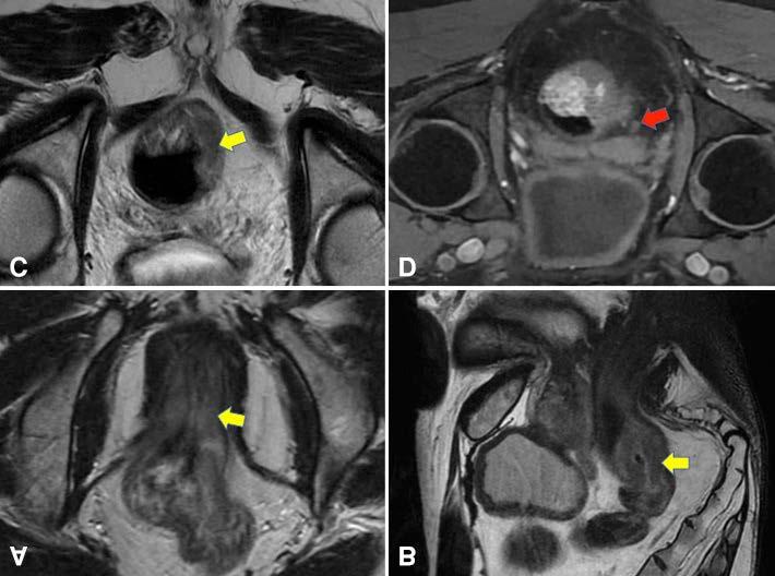 Axial T2-weighted MRI showing a mid-rectal tumor (yellow arrow) invading the prostate gland (white arrow). Figure 7.