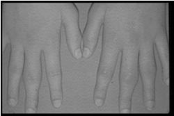 1. Persistent swelling leads to erosions which lead to joint deformities Rationale