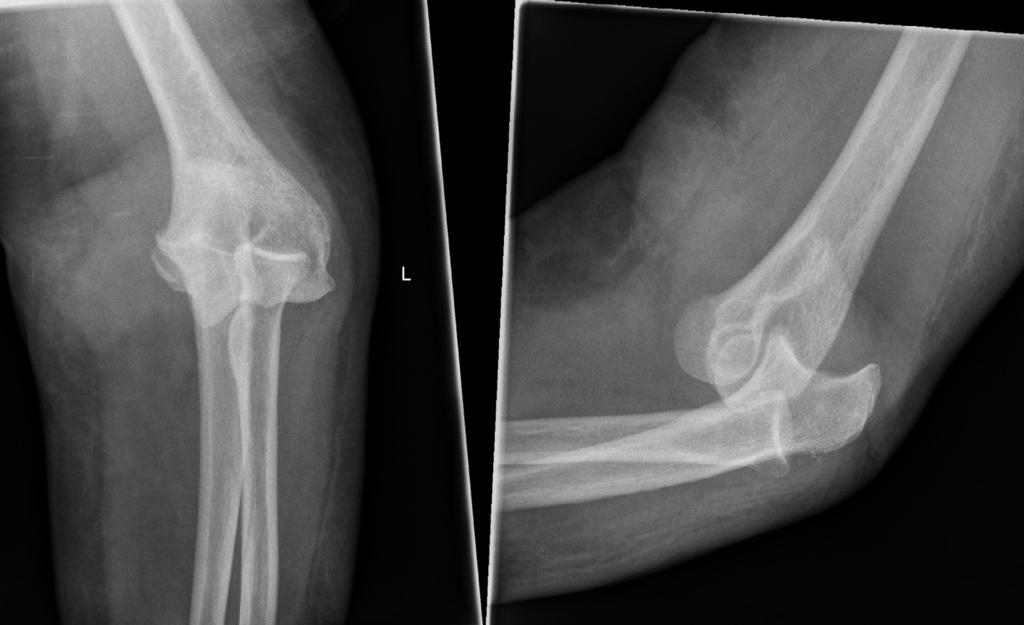 M. Harris et al.: SICOT J 2016, 2, 15 3 Figure 3. Elbow AP and lateral radiographs three weeks post injury showing dislocation. Figure 4. Diagram of triceps tendon (A) reconstruction and suture (B).