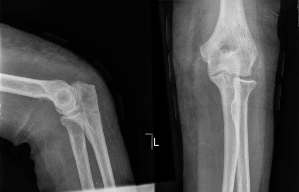 4 M. Harris et al.: SICOT J 2016, 2, 15 Figure 5. Elbow AP and lateral radiographs two weeks post initial reconstruction. Figure 6.