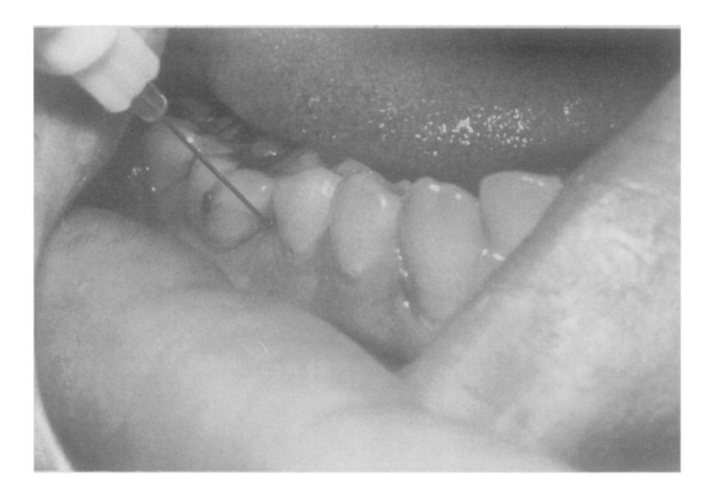 I 18 Malamed Oral Surg. February, 1982 Fig. 2. To achieve anesthesia of first molar, separate injections are required on the mesial and distal roots. Table Fig. 1. A, Peri-Press syringe for PDL injection.