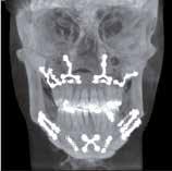 fractures, bone density and depth, information of the TMJ and