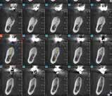 3D images highlight the cortical bone the device s less