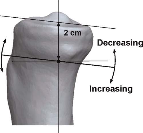226 SHELBURNE ET AL. Figure 3. Posterior tibial slope in the model was changed by rotating the tibial plateau about an axis 2 cm below the distal plateau and centered on the long axis of the tibia.