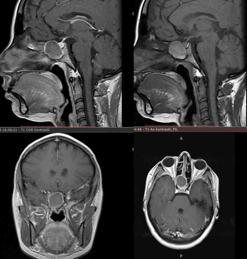 Romanian Neurosurgery (2016) XXX 4: 520 525 521 neurological deficit. No abnormality was present on laboratory analyses. The patient was operated through the transnasal transsphenoidal route.