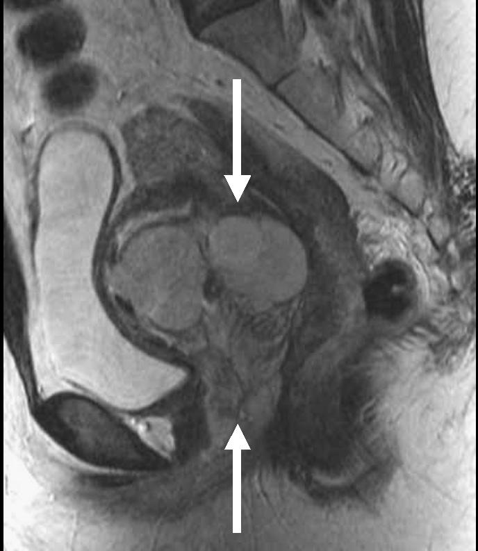 The axial fat-saturated postcontrast T1-weighted image (TR/TE, 600/14) shows homogeneous strong enhancement (arrows).