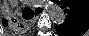 endartherectomy Ascending aorta