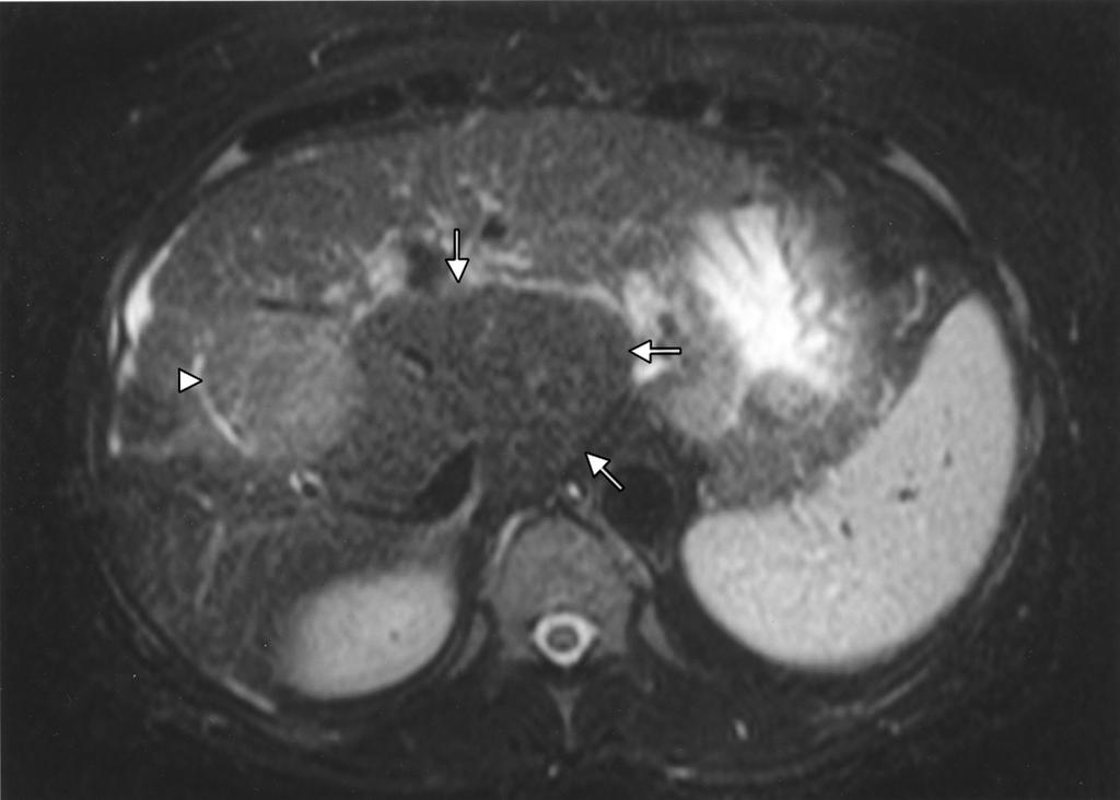 The nodularity is best seen affecting the liver margin, especially on the left lateral segment.