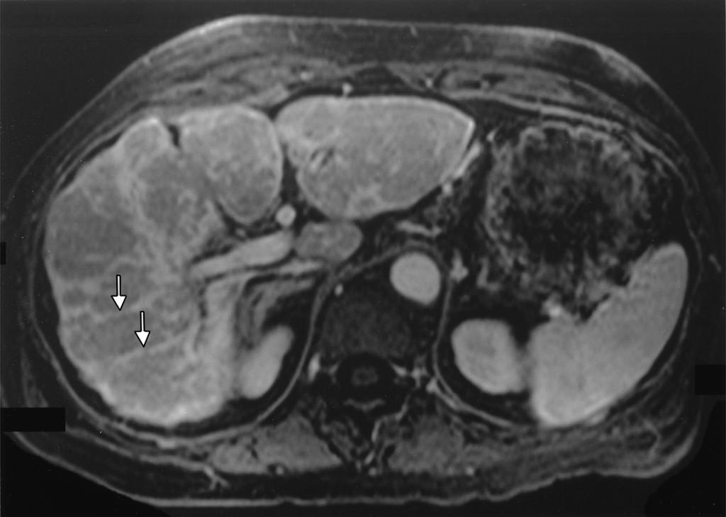 T and MRI of irrhosis Fig. 3. 74-year-old woman with metastatic -cell lymphoma.