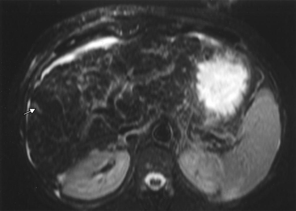 Gupta et al. D Fig. 4. (continued) 51-year-old woman with metastatic breast carcinoma.