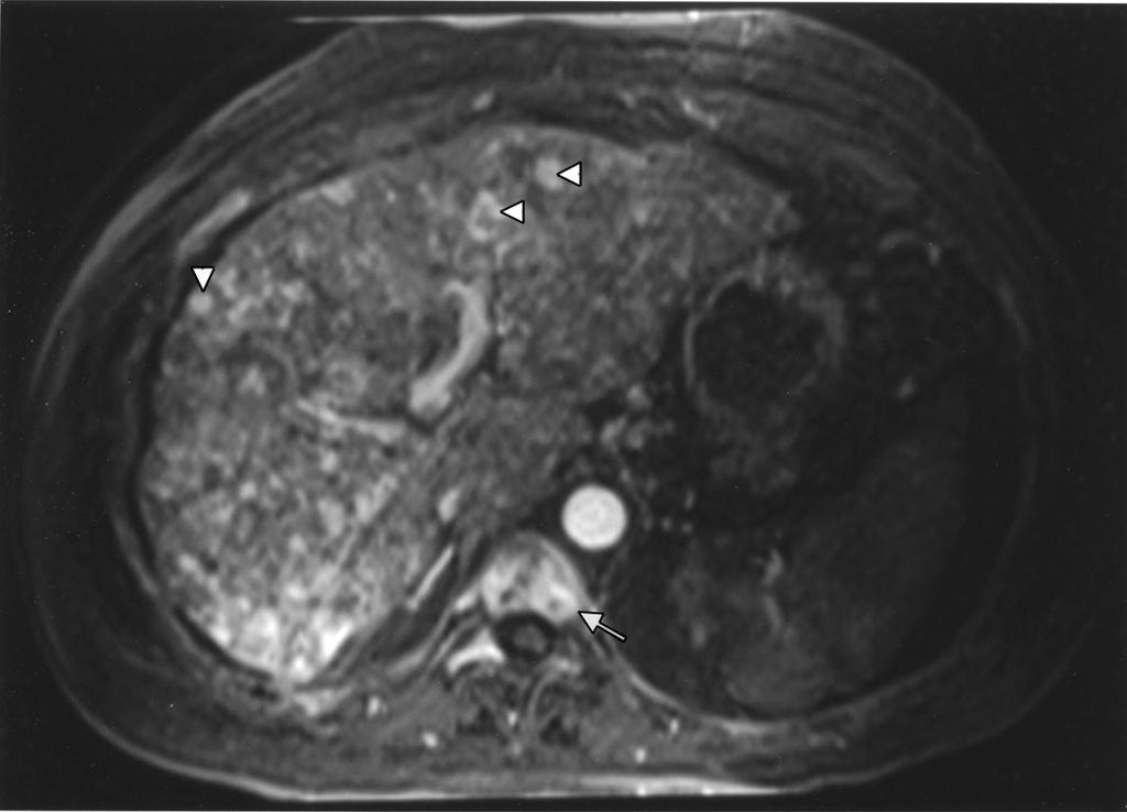 ommon imaging findings include a lobular margin, volume loss caudate hypertrophy, and portal hypertension and can be observed within a few weeks or months after therapy [2, 3] (Figs. 3 and 4).