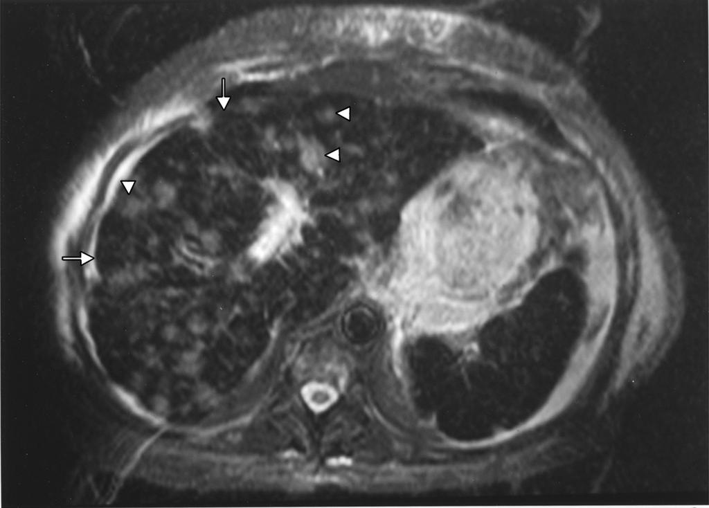 Frequently, patients have a residual tumor that is difficult to detect given the morphologic abnormalities.
