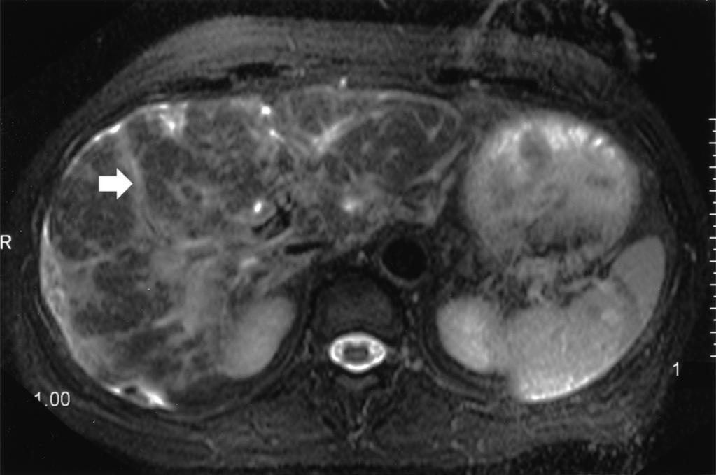 T and MRI of irrhosis Fig. 6. 59-year-old woman with subacute hepatic necrosis of unknown cause.