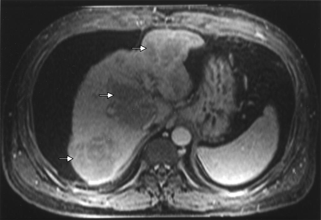 parenchyma (arrow). Fig. 7. 37-year-old man with fulminant hepatic necrosis secondary to drug toxicity.