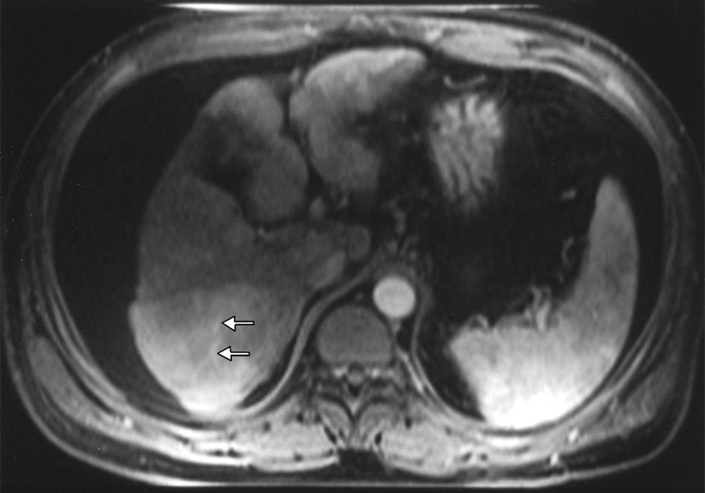could be confused with hepatocellular carcinoma in setting of cirrhosis. Marked ascites is present.