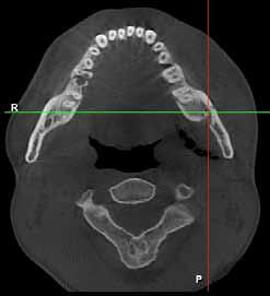 The Utility of CCT Imaging Technique in Maxillofacial Trauma Table I The frequency of fractures according to their