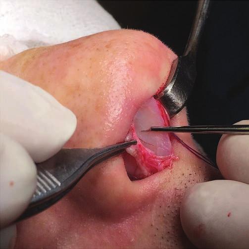 3,4,7,10 As is known, the subperichondrial plane is the standard plane for septoplasty to improve the healing process and prevent complications.