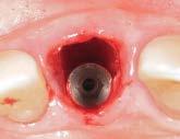 In patients with buccal bone wall defects, the missing socket wall was reconstructed using a corticocancellous graft harvested from the same donor site, following the immediate dentoalveolar