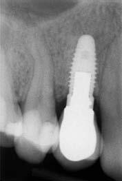 258 Figs 3a and 3b (left) Radiographic and (right) clinical esthetic outcomes of a single implant in the maxillary right first premolar region showing successful osseointegration after 24 months.