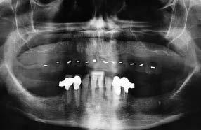 261 Fig 5a Preoperative radiographic situation of an edentulous maxilla in a woman undergoing bisphosphonate treatment for osteoporosis.