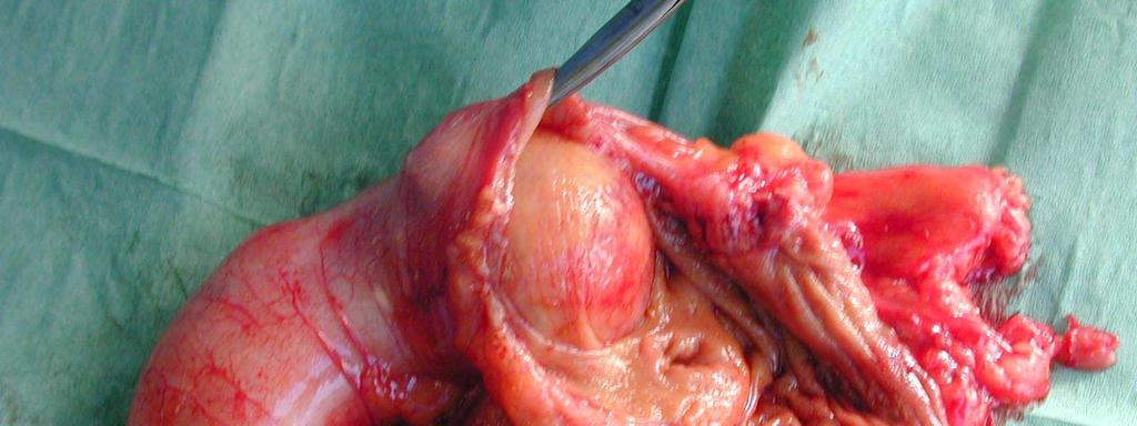 Carcinomatosis from appendiceal