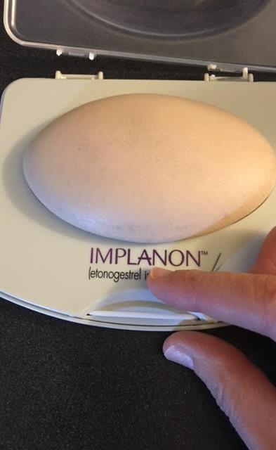 7 Implant