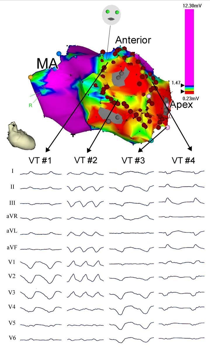 Integrated approach Creation of voltage map during sinus rhythm Annotation of Fragmented signals Late potentials
