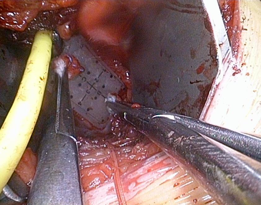 Surgery for VT Intraoperative mapping