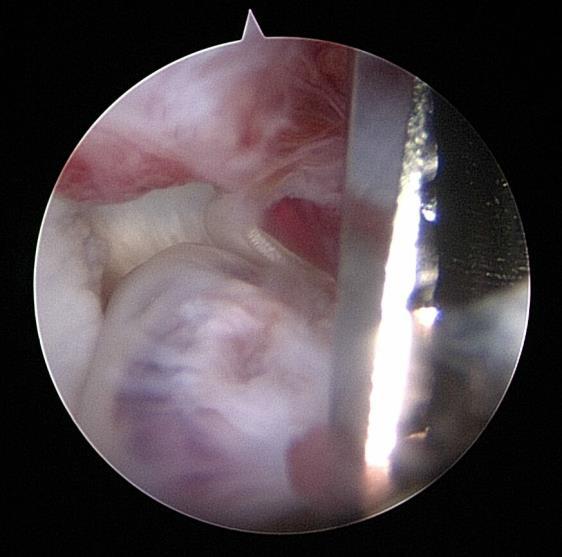 Ruptured cruciate being arthrocopically debrided with a 3.0mm motorized shaver. Torn meniscus being arthroscopically debrided with a radiofrequency ablation probe.