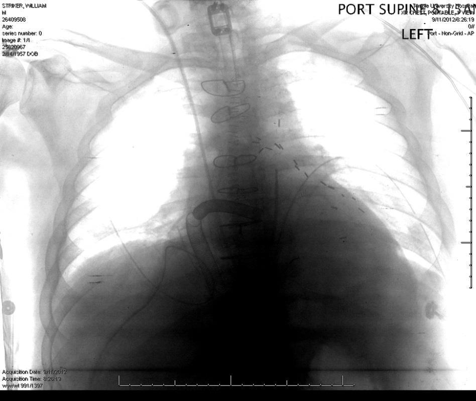Case. 55 M, acute on chronic heart failure, ischemic