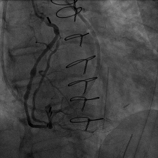 Case. 61F, Cardiogenic shock