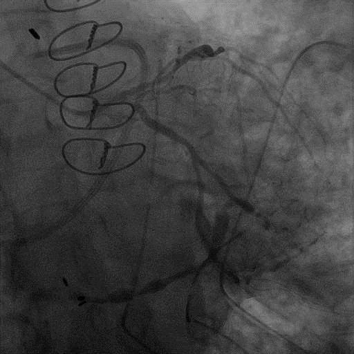 cardiac output, Ventricular