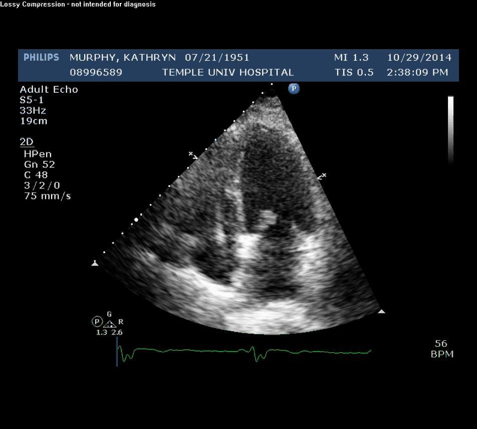 Case. 61F, Cardiogenic shock following STEMI S/P Emergency