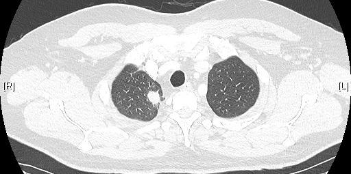 Case of Pathological Complete Response in One Patient Treated With Nivo 3 Q 2 W + Ipi 1 Q 6 W 4-year-old male (former smoker, 2