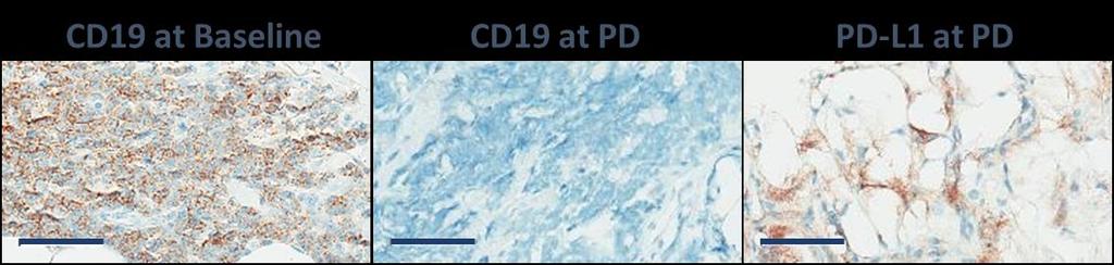 PD-L1 N/E 1/14 (7) PD-L1+ 4/7 (57) PD-L1-2/7 (29) PD-L1 N/E 1/7 (14) Post-progression tumor biopsies (21 evaluable
