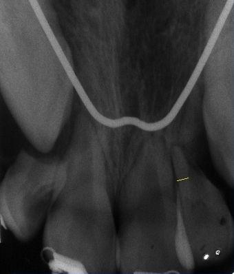 Radiographic examination of the teeth showed immature roots with open apices with very short root development.