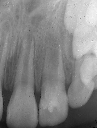 Siragusa, M. Health Sciences Female patient, age 7. Revascularization Protocol All teeth were treated by a common, 2-visit regenerative endodontic protocol.